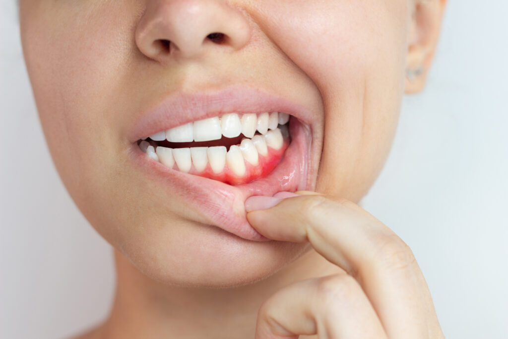 Caring for Sensitive or Bleeding Gums